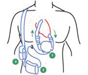 A ventricular assist device